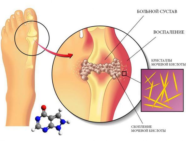Поражение сустава при подагре