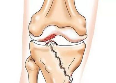 Формирование артроза в результате перелома внутреннего мыщелка большеберцововой кости