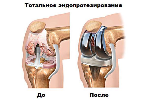 Тотальное эндопротезирование