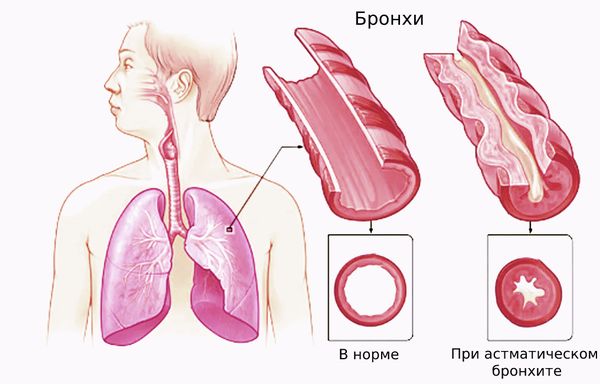 Астматический бронхит