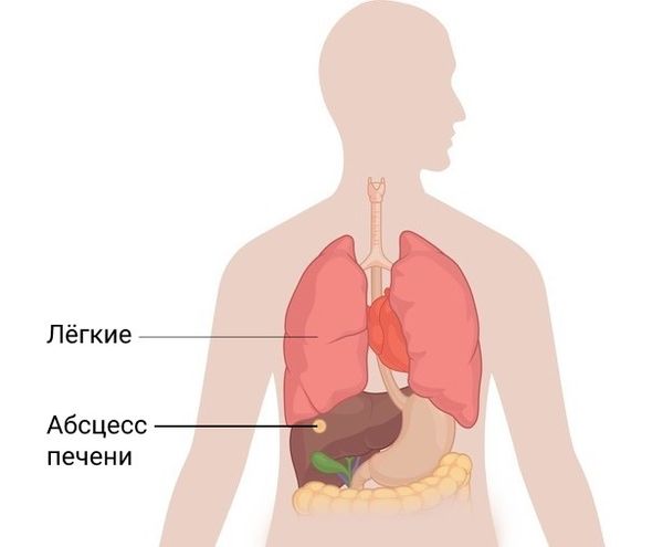 Абсцесс печени