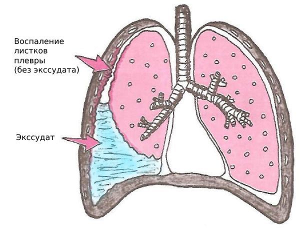 Экссудативный плеврит