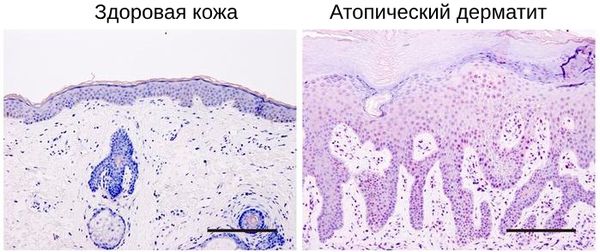Строение ткани при атопическом дерматите 