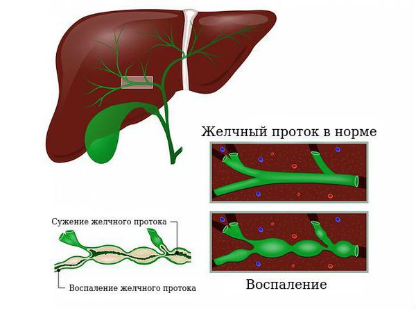 Желчный проток в норме и при воспалении