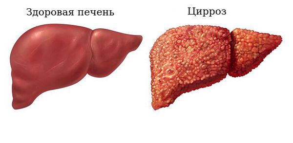 Здоровая печень и цирроз