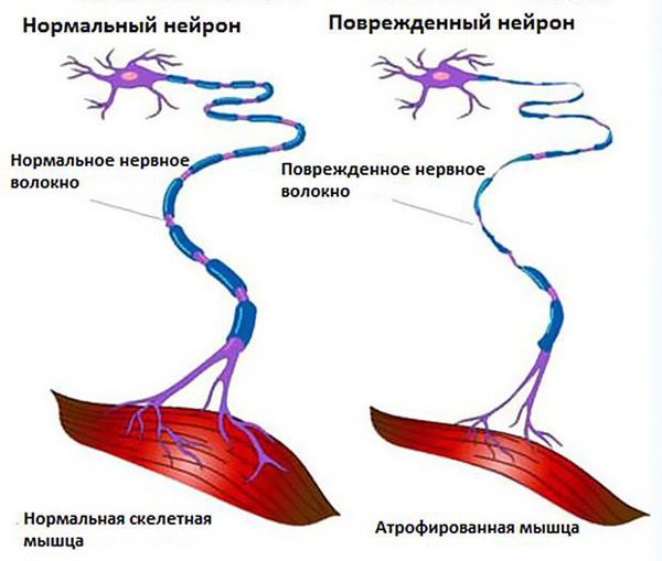 Нормальный и повреждённый нейрон