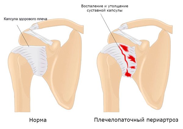 Плечелопаточный периартроз