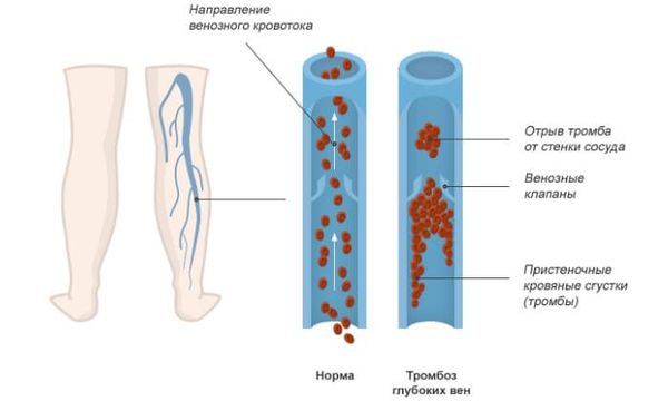 Тромбоз глубоких вен нижних конечностей