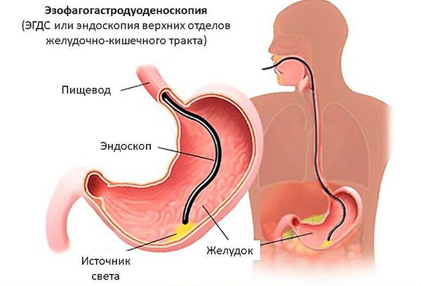 Эзофагогастродуоденоскопия