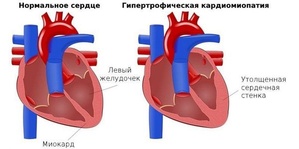 Гипертрофическая кардиомиопатия