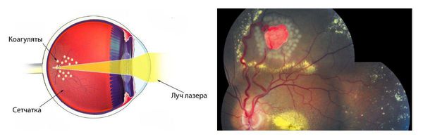 Фотокоагуляция границ опухоли