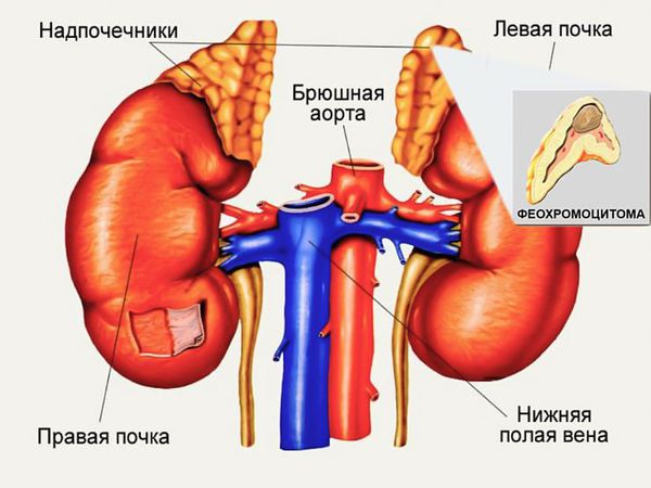 Феохромоцитома