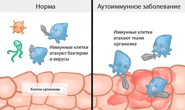 Патогенез аутоиммунных заболеваний