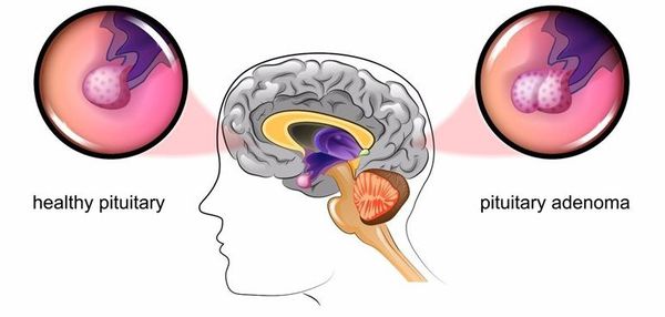 Микроаденома гипофиза