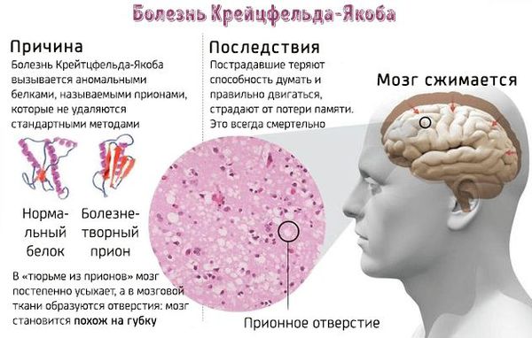 Причины болезни Крейсфельдта – Якоба