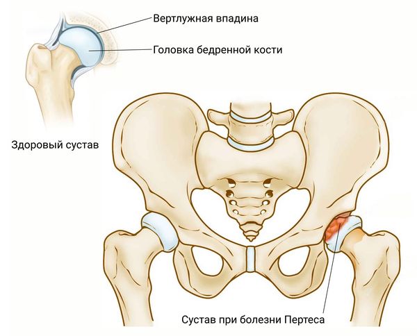 Болезнь Пертеса' data-blur='False