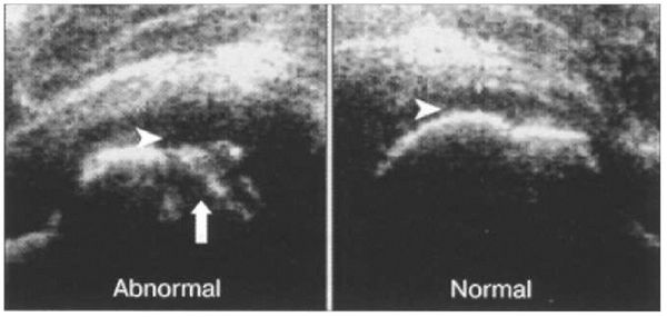 Ультразвуковые изменения при болезни Пертеса ' data-blur='False
