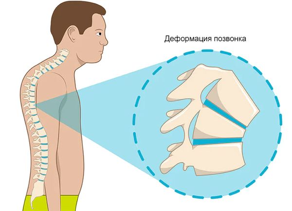 Болезнь Шейермана — Мау