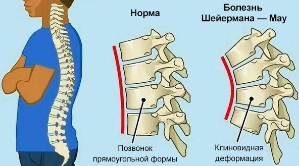 Клиновидная деформация позвонков