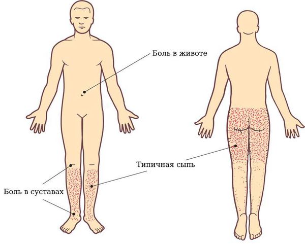 Симптомы болезни Шенлейн — Геноха