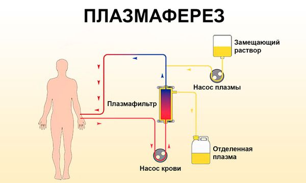 Плазмаферез