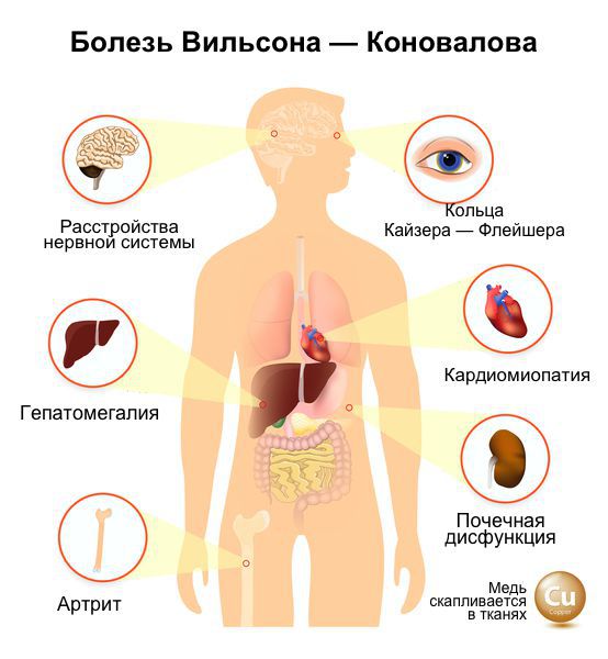 Болезнь Вильсона — Коновалова