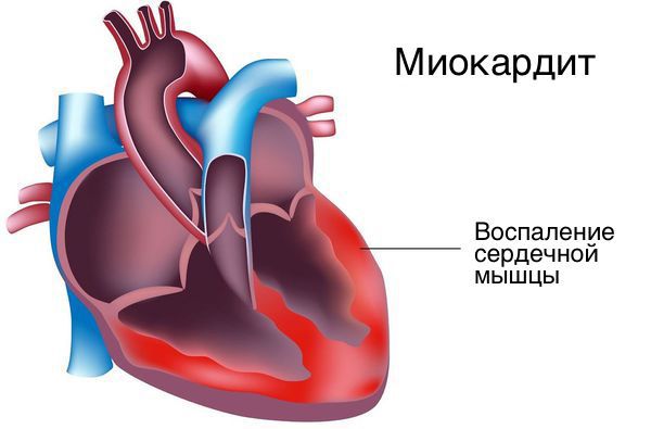 Миокардит