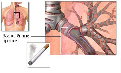 Бронхит курильщика
