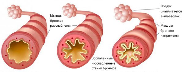 Обструкция бронхов