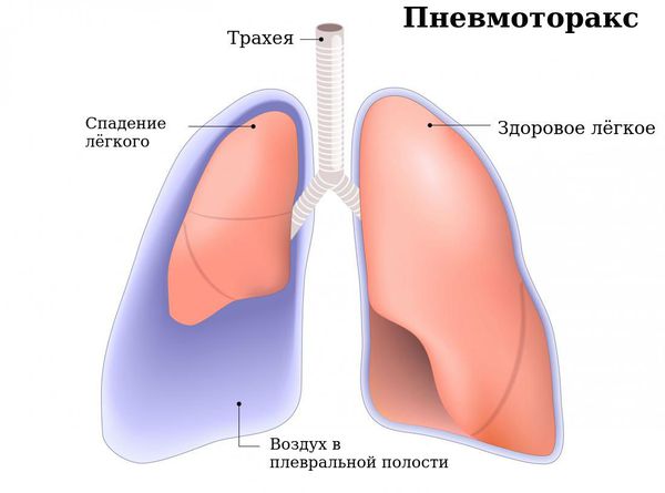 Пневмоторакс