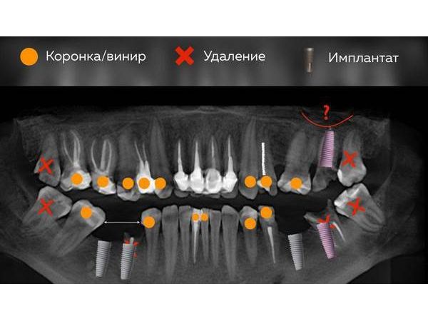 Рентген и план лечения