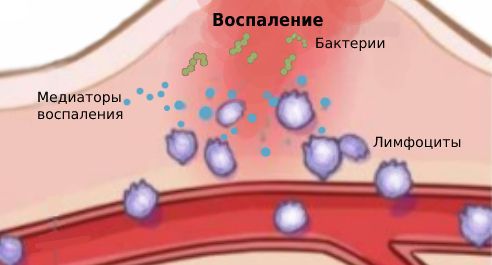 Патогенез воспалительной реакции