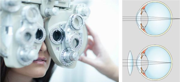 Оптическая коррекция дальнозоркости