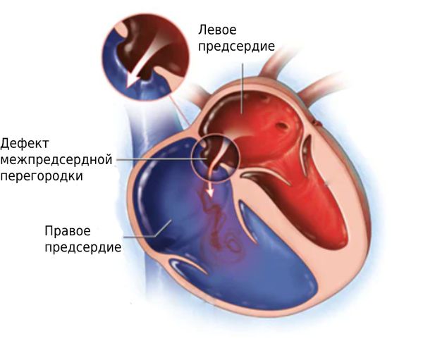 Дефект межпредсердной перегородки