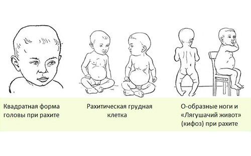 Рахит у детей