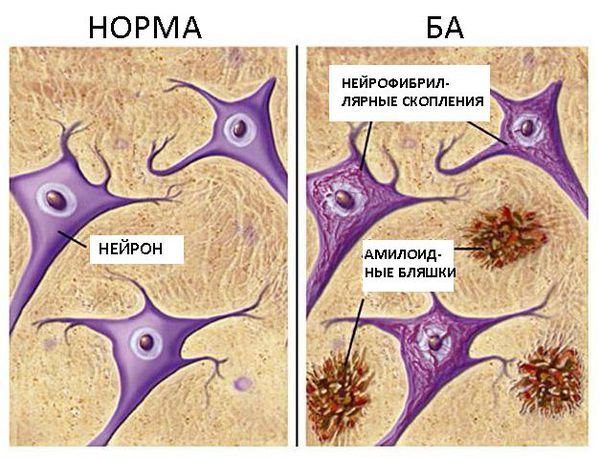 Деменция при болезни Альцгеймера