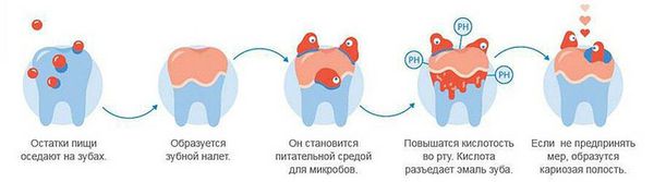 Этапы развития деминерализации и кариеса