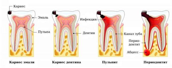 Осложнения деминерализации