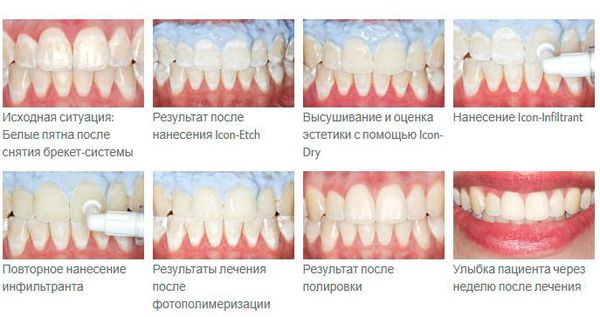 Лечение по технологии Icon 