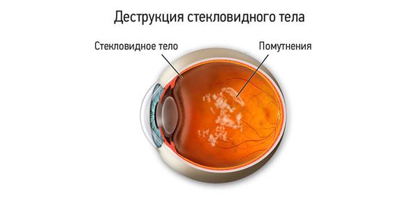 Деструкция стекловидного тела