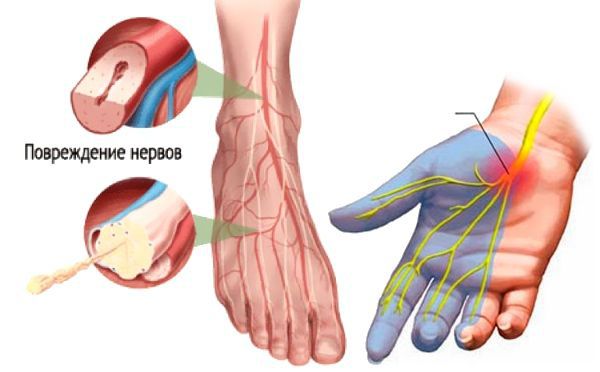 Повреждение нервных волокон