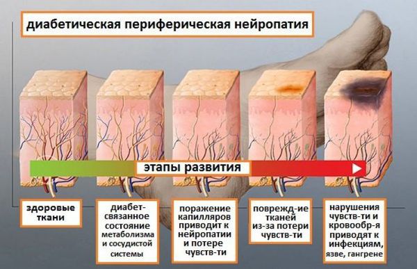 Стадии развития ДПН