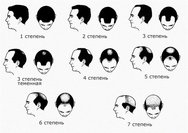 Выраженность потери волос у мужчин по шкале Норвуда