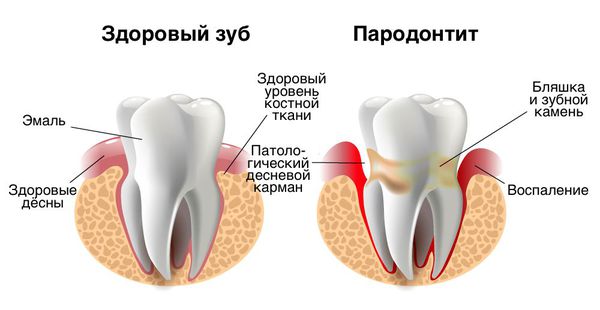 Пародонтит