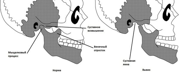 Вывих суставной головки височно-нижнечелюстного сустава