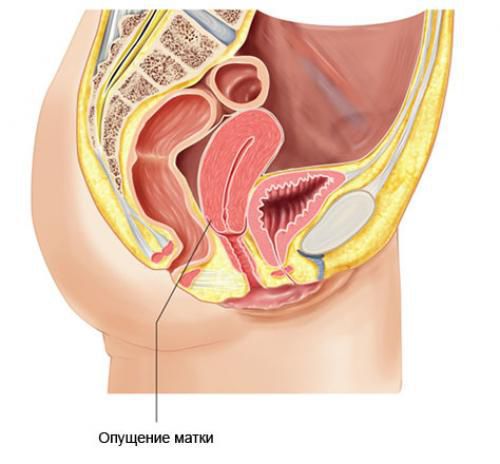 Опущение матки