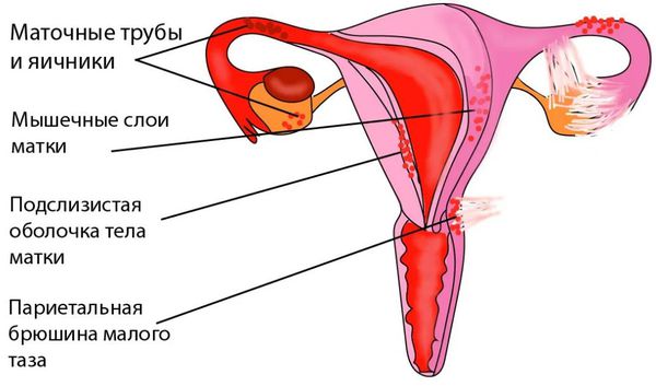 Эндометриоидные очаги