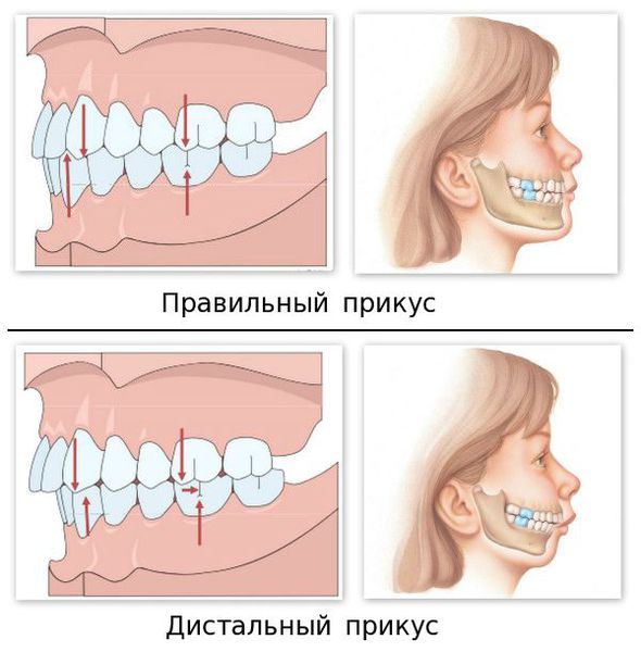 Правильный прикус и дистальный прикус