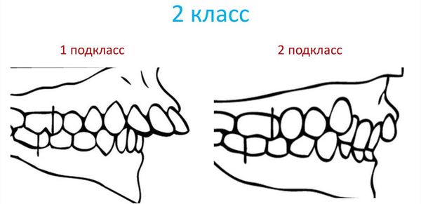 Классификация Энгля