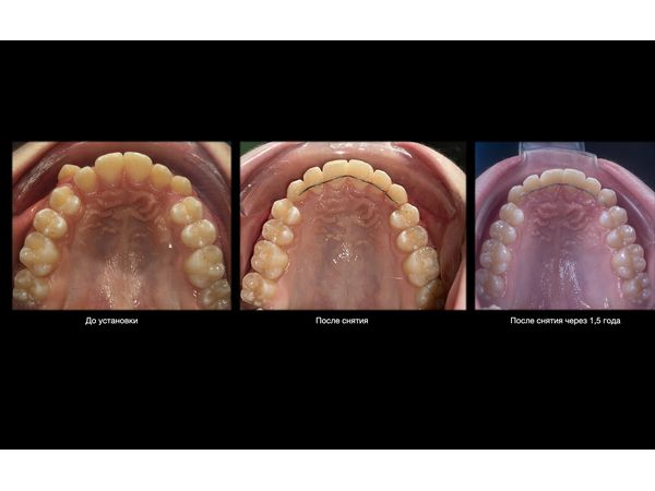 Результат лечения: верхняя челюсть 